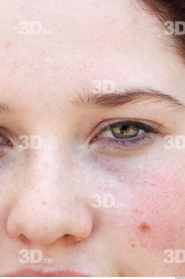 Eye Woman White Birthmarks Average